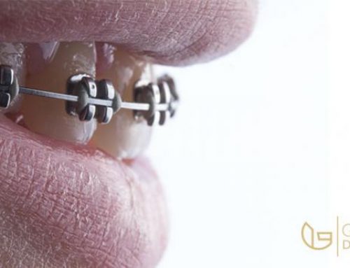 9 + 1 Myths for orthodontic treatment